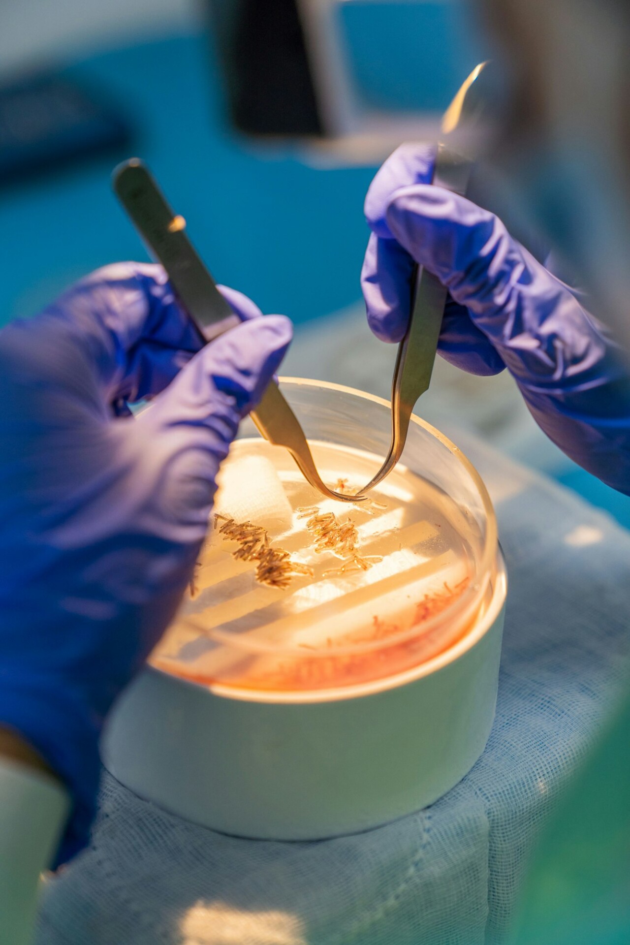 Hair surgeon making the selection of follicular units with tweezers for hair transplantation.